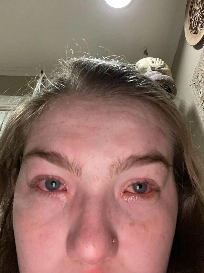 凯发在线平台笑哭！女子满脸爆痘眼睛长满皮